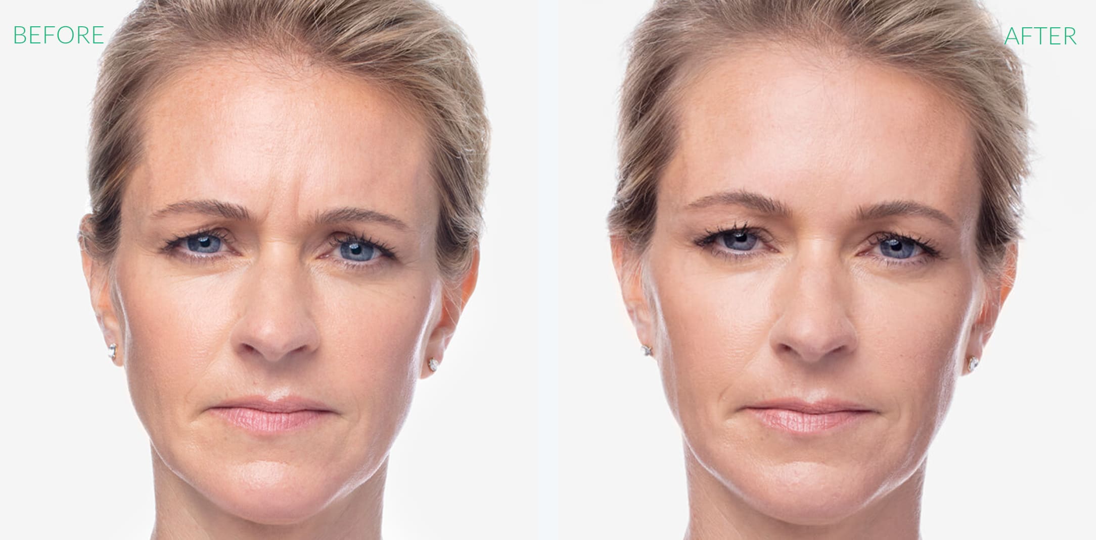 Dysport Before & After