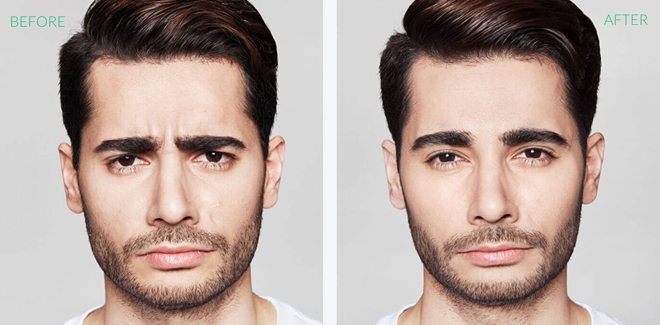 Dysport Before & After