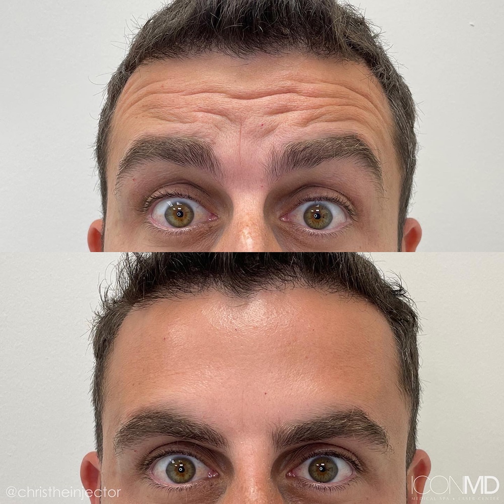 Botox® Before and After Photo by IconMD Medical Spa & Laser Center in Boca Raton