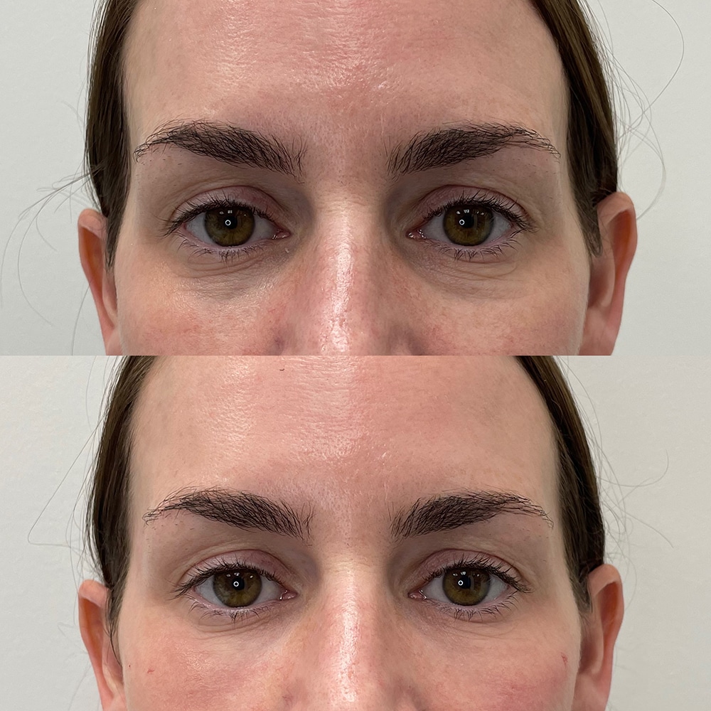 Botox® Before and After Photo by IconMD Medical Spa & Laser Center in Boca Raton