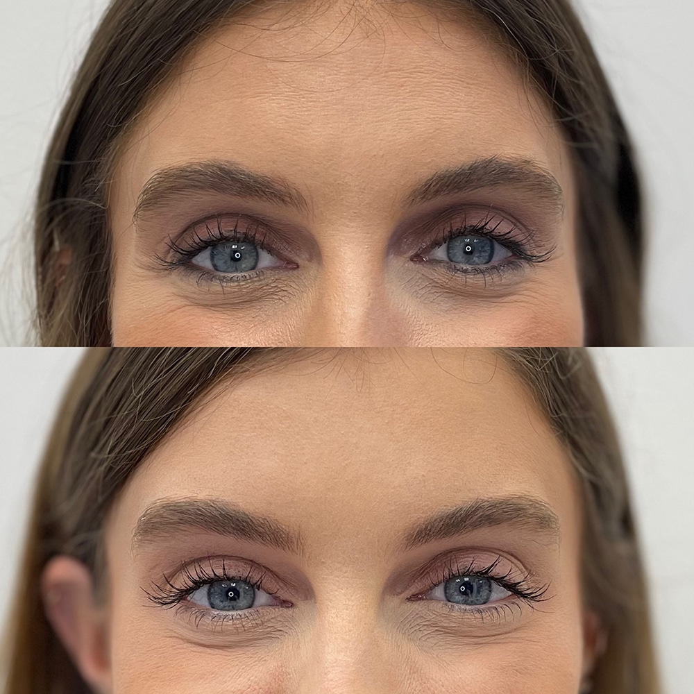 Botox® Before and After Photo by IconMD Medical Spa & Laser Center in Boca Raton