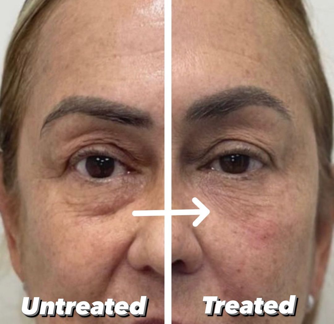 Belotero before and after photo by IconMD Medical Spa + Laser Center in Boston and Waltham Massachusetts