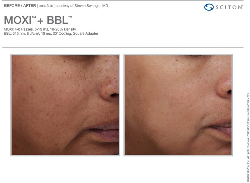 MOXI + BBL Combo Before and After