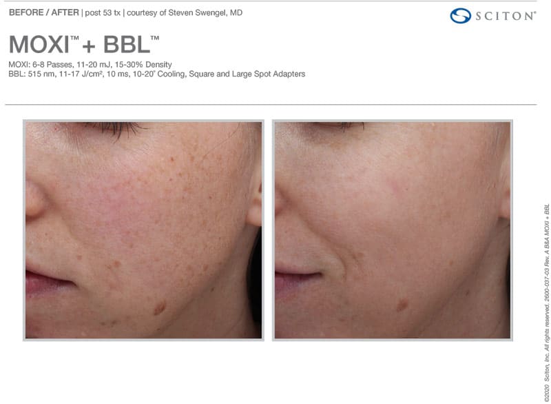 MOXI + BBL Combo Before and After