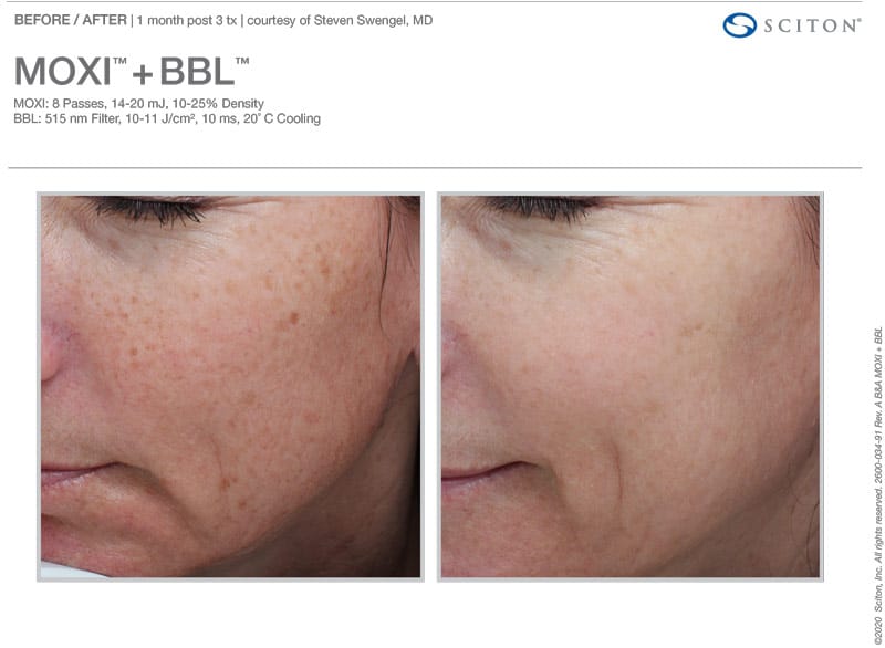MOXI + BBL Combo Before and After
