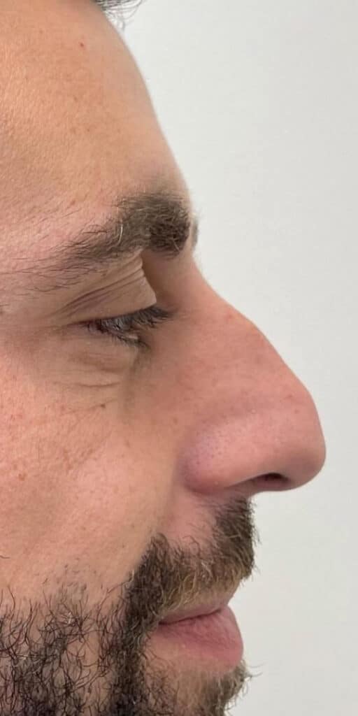 Non-Surgical Nose Job