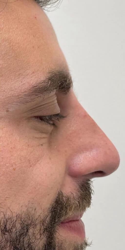 Non-Surgical Nose Job