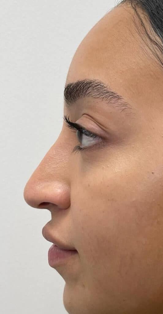 Non-Surgical Nose Job