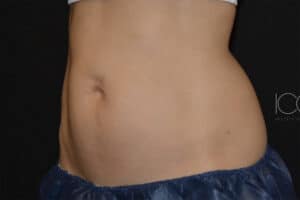 Coolsculpting Elite