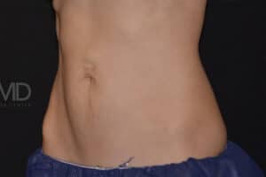 Coolsculpting Elite