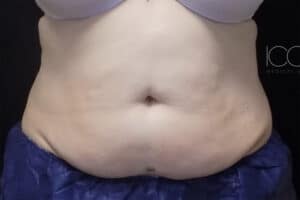 Coolsculpting Elite