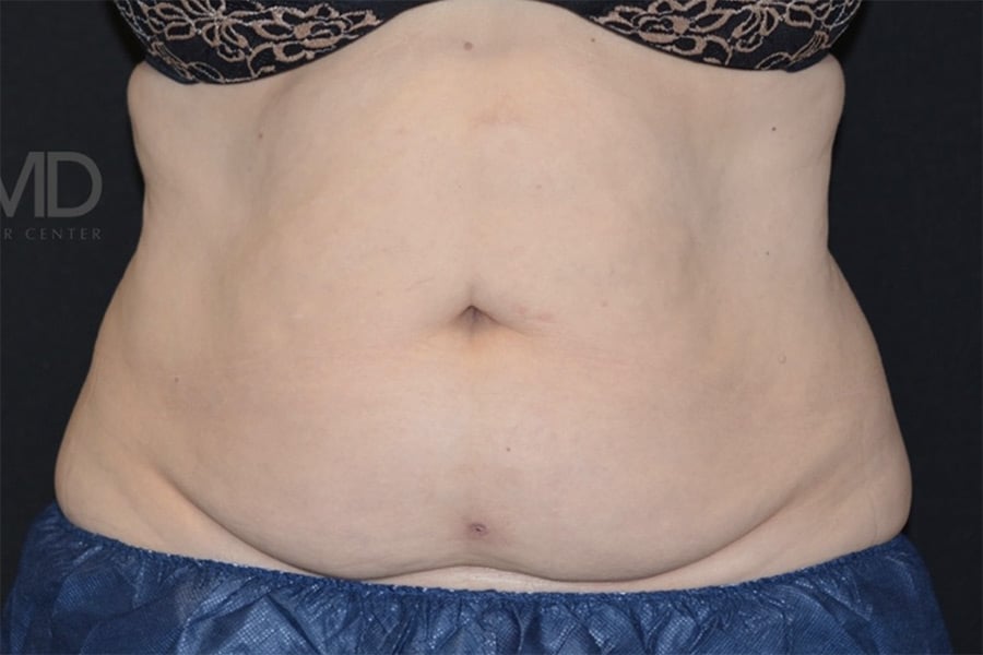 Coolsculpting Elite