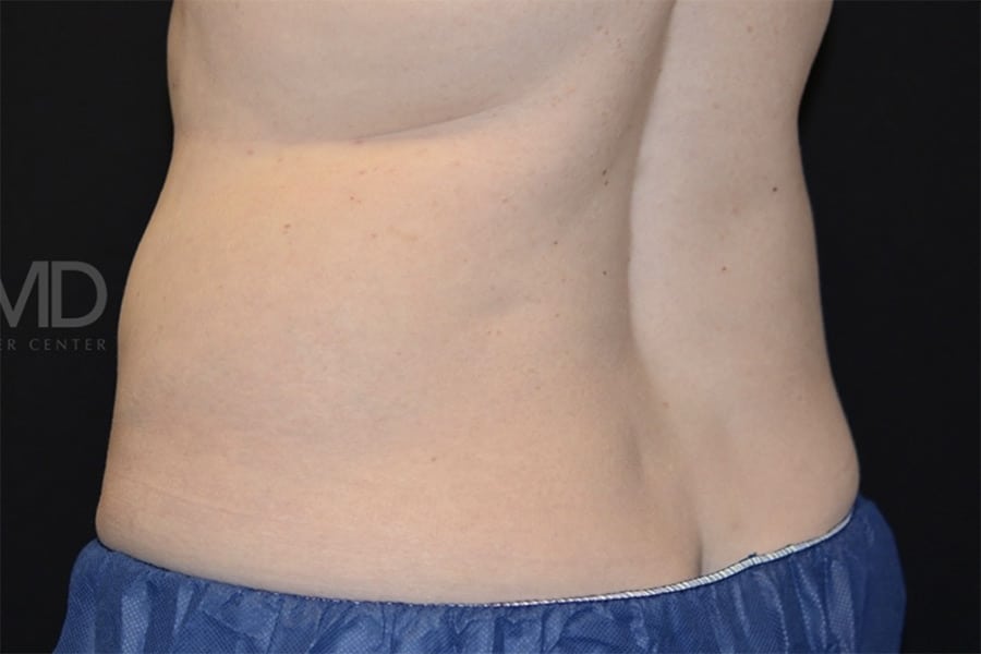 Coolsculpting Elite