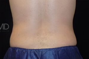 Coolsculpting Elite