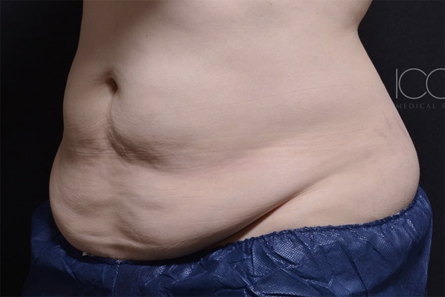 Coolsculpting Elite