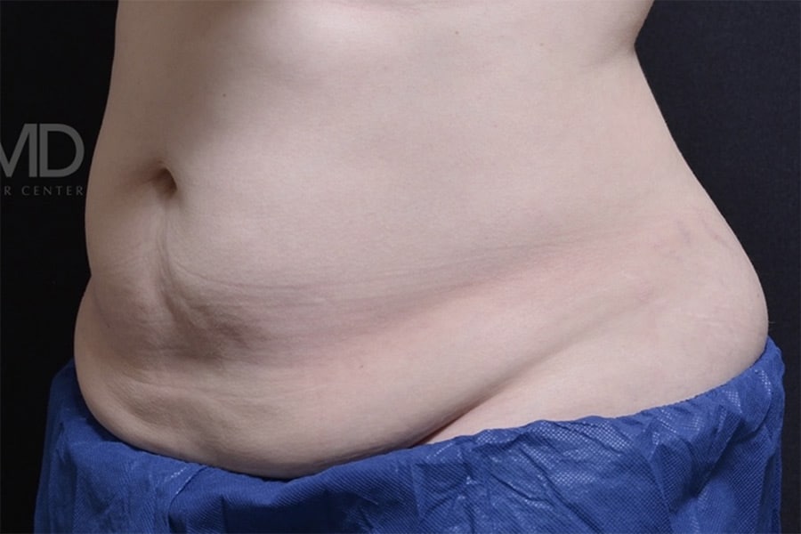 Coolsculpting Elite