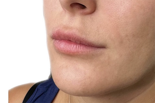 Lip Filler