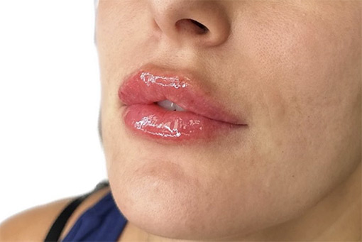 Lip Filler
