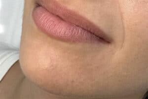 Lip Filler