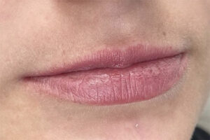 Lip Filler