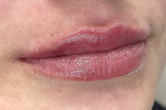 Lip Filler