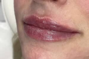 Lip Filler