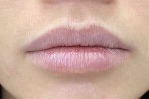 Lip Filler