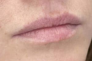 Lip Filler