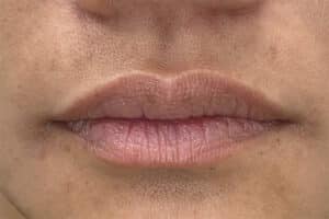 Lip Filler