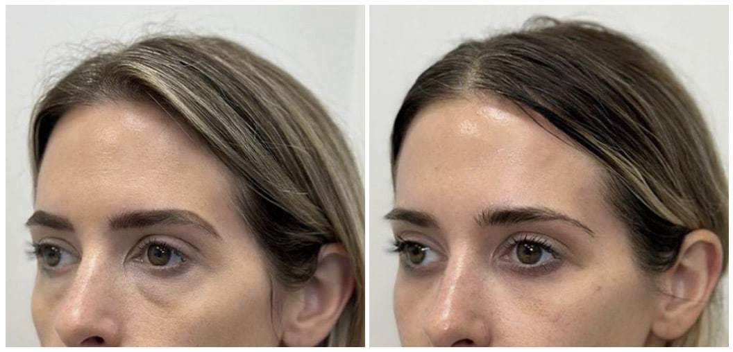 RHA Filler Before and After Photo by IconMD Medical Spa & Laser Center in Boston and Waltham