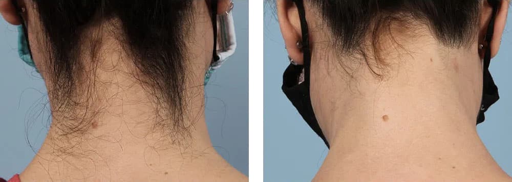 Laser Hair Removal Before & After Boca Raton, Pompano Beach And Fort Lauderdale