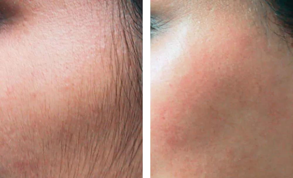 Laser Hair Removal Before & After Boca Raton, Pompano Beach And Fort Lauderdale