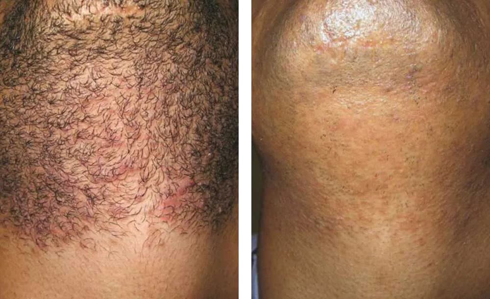 Laser Hair Removal Before & After Boston and Waltham Massachusetts