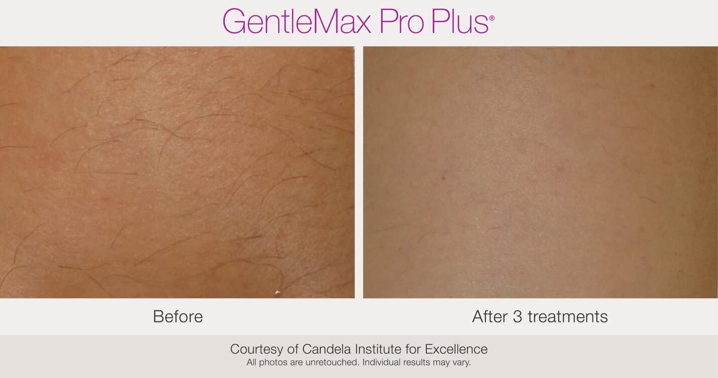 Laser Hair Removal Before & After Boca Raton, Pompano Beach And Fort Lauderdale