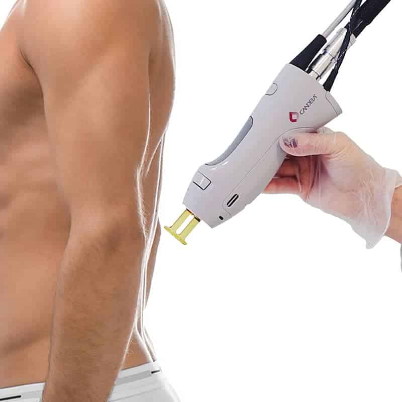 A man receiving laser hair removal treatment on his back.