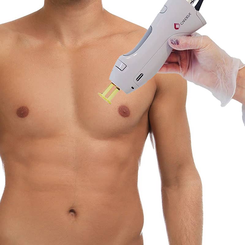 Laser Hair Removal Chest