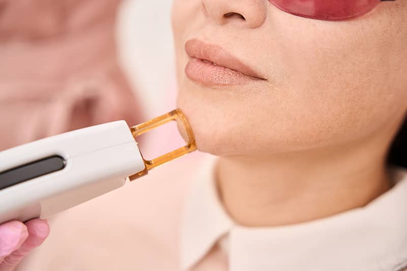 A woman receiving laser hair removal treatment on her chin.