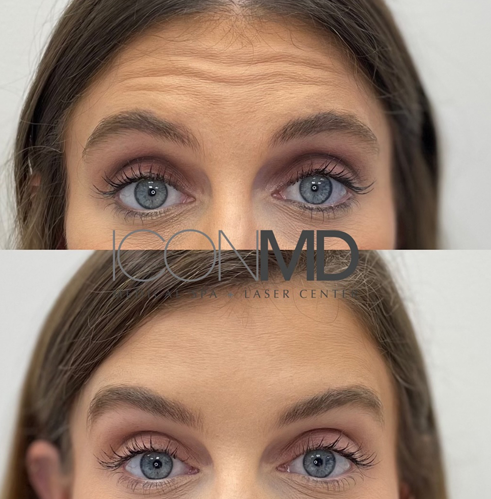 Botox® Before and After Photo by IconMD Medical Spa & Laser Center in Waltham Massachusetts