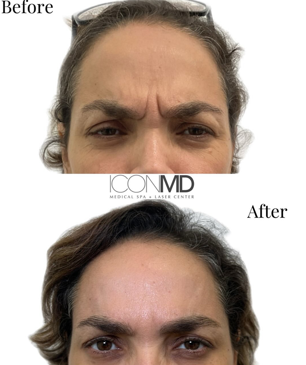 Botox® Before and After Photo by IconMD Medical Spa & Laser Center in Waltham Massachusetts