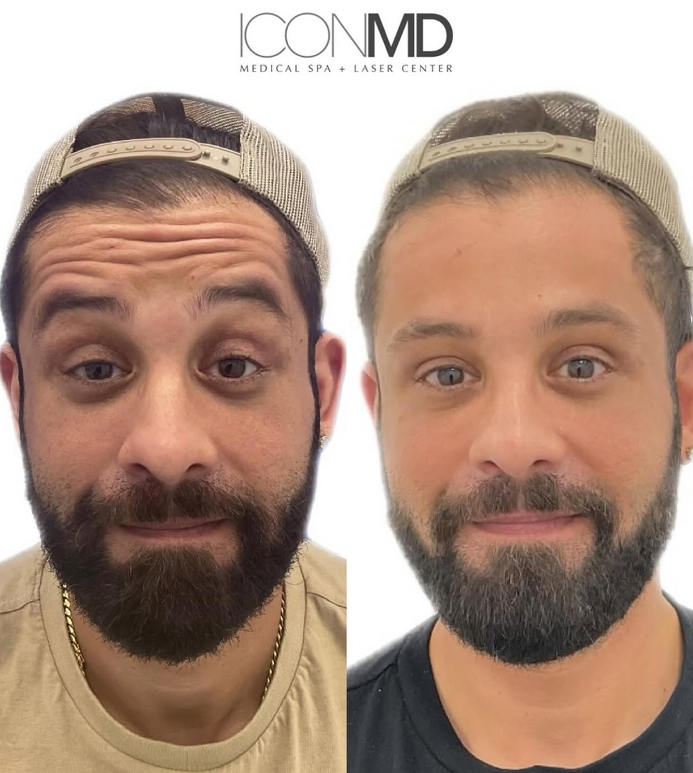 Botox® Before and After Photo by IconMD Medical Spa & Laser Center in Waltham Massachusetts