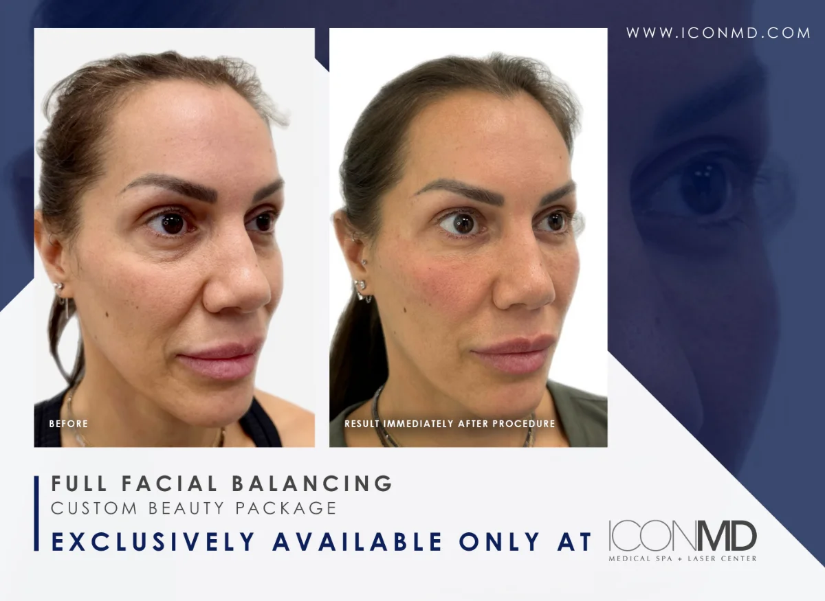 IconMD Facial Balancing Promo