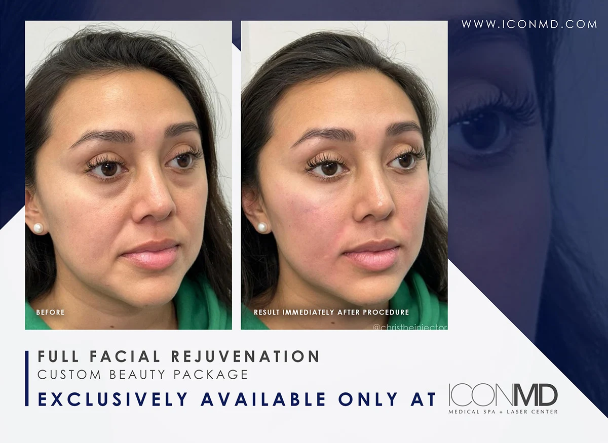 IconMD Facial Rejuvenation 2 Promo