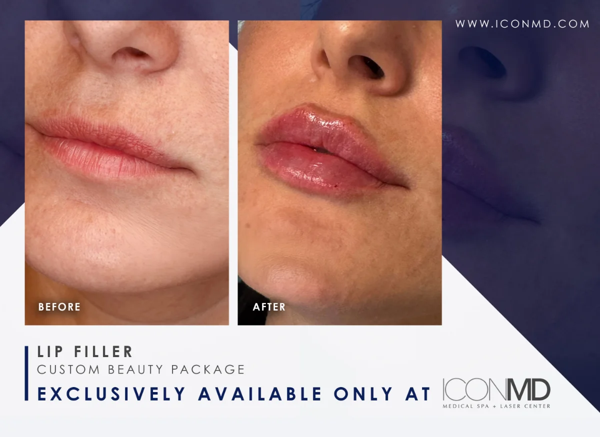 IconMD Lip Filler Removal Promo