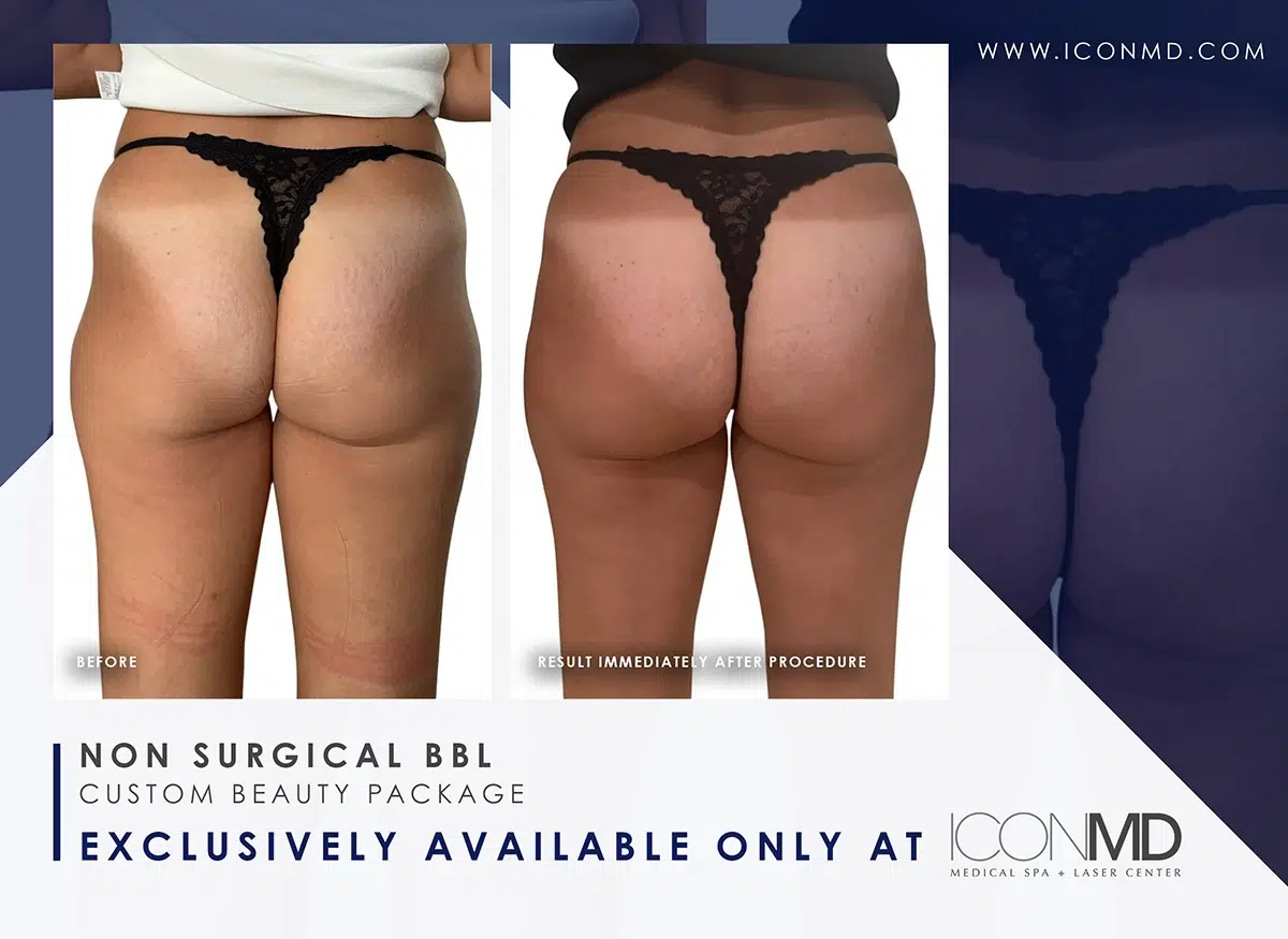 IconMD Non surgical BBL Promo